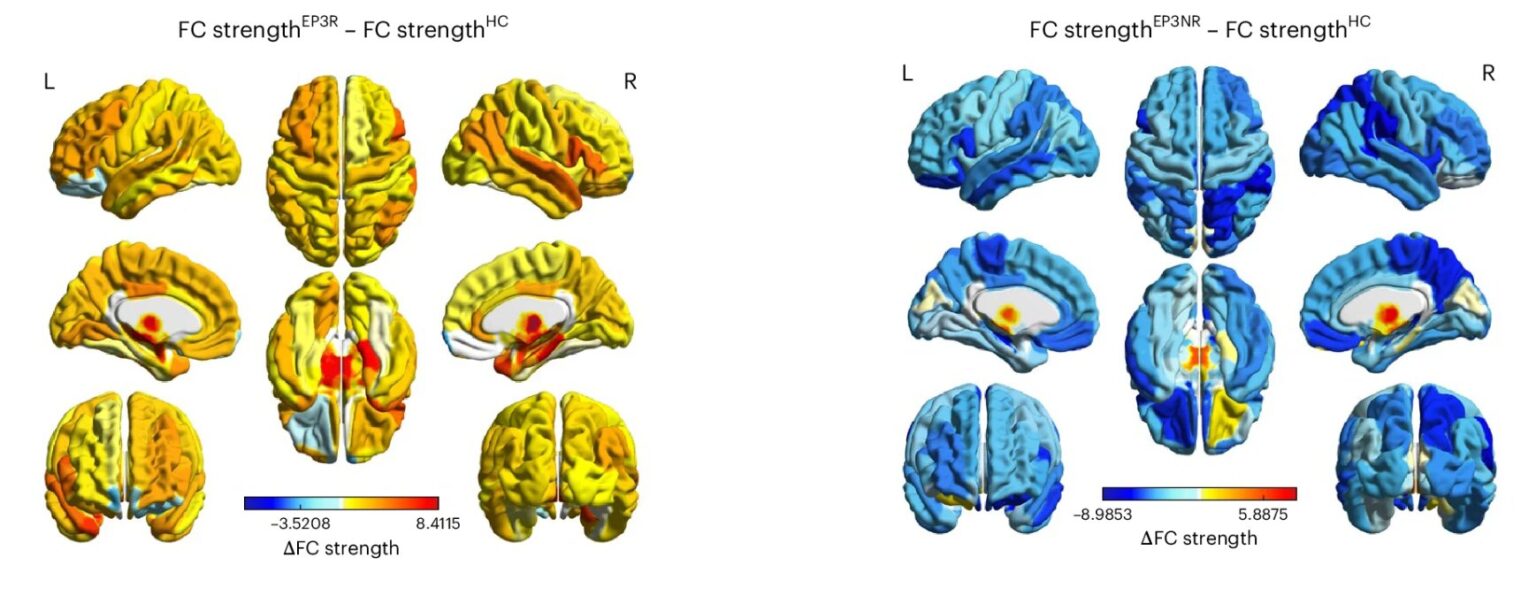 Brain Study Reveals Why Psychosis Sometimes Disappears